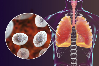 aids_lung