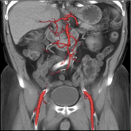 Abdomen Aorta CT Scan