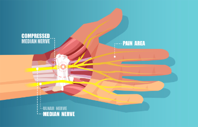 diagram of compressed median nerve