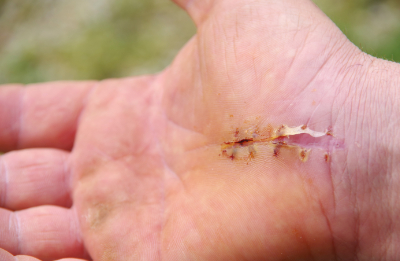 picture of patient recovering from carpal tunnel syndrome surgery