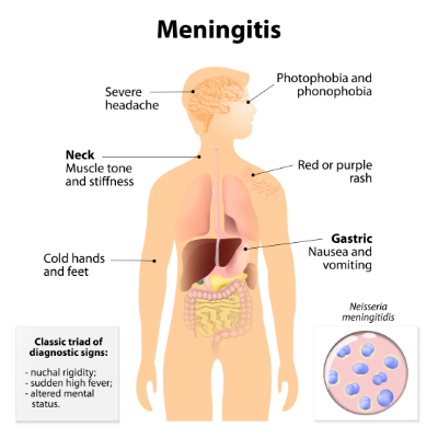 meningococcal_disease_symptoms